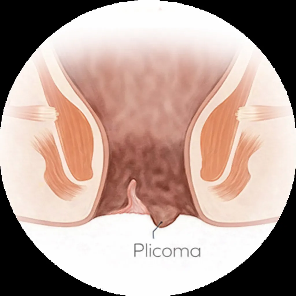 Ilustração de plicoma anal na borda do ânus