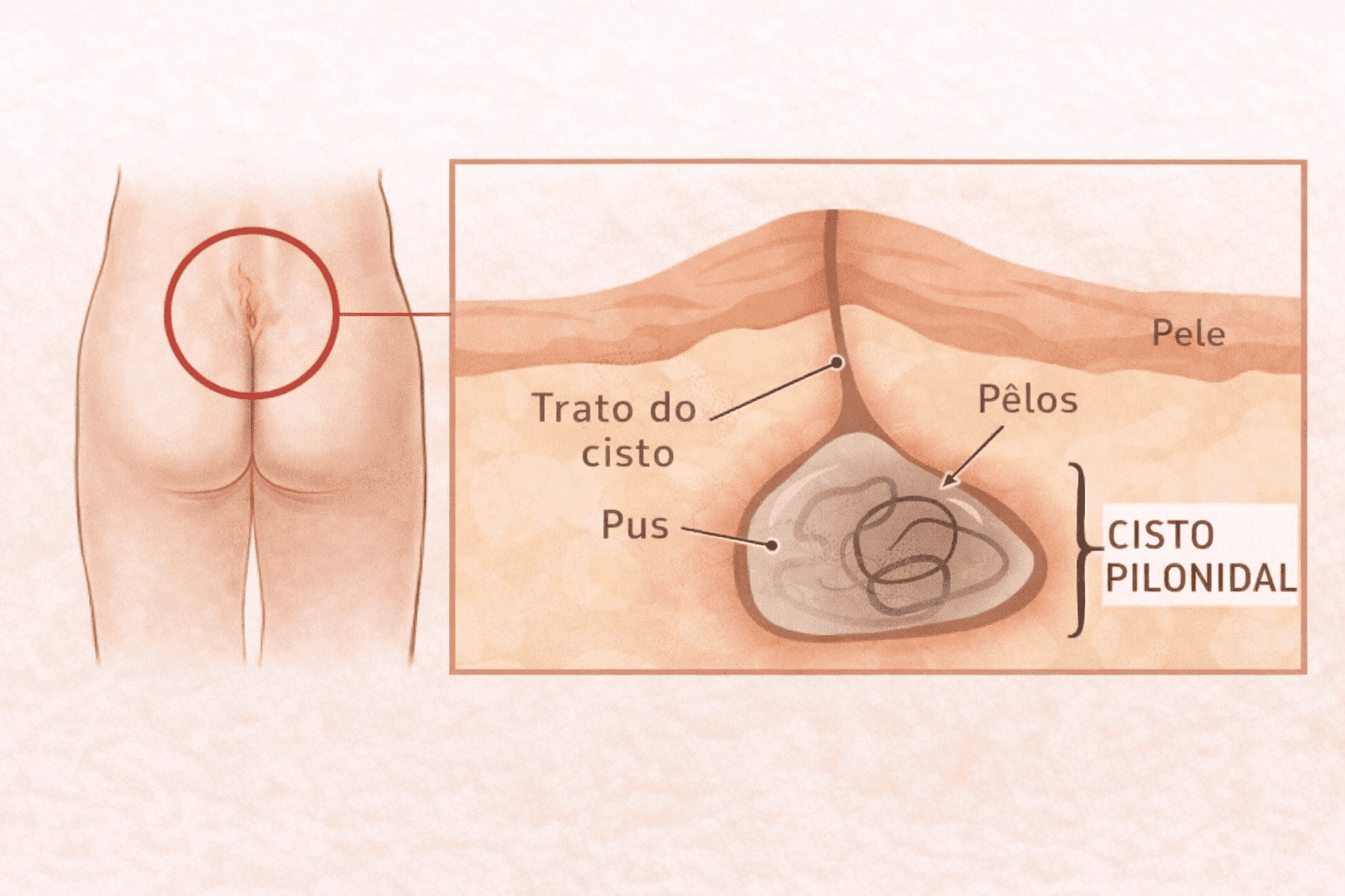 Ilustracao anatomica de cisto pilonidal