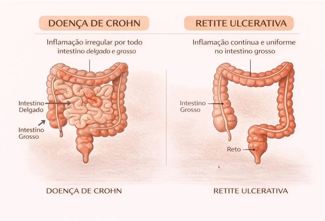 Principais manifestações clínicas da Doença de Crohn e da Retocolite Ulcerativa