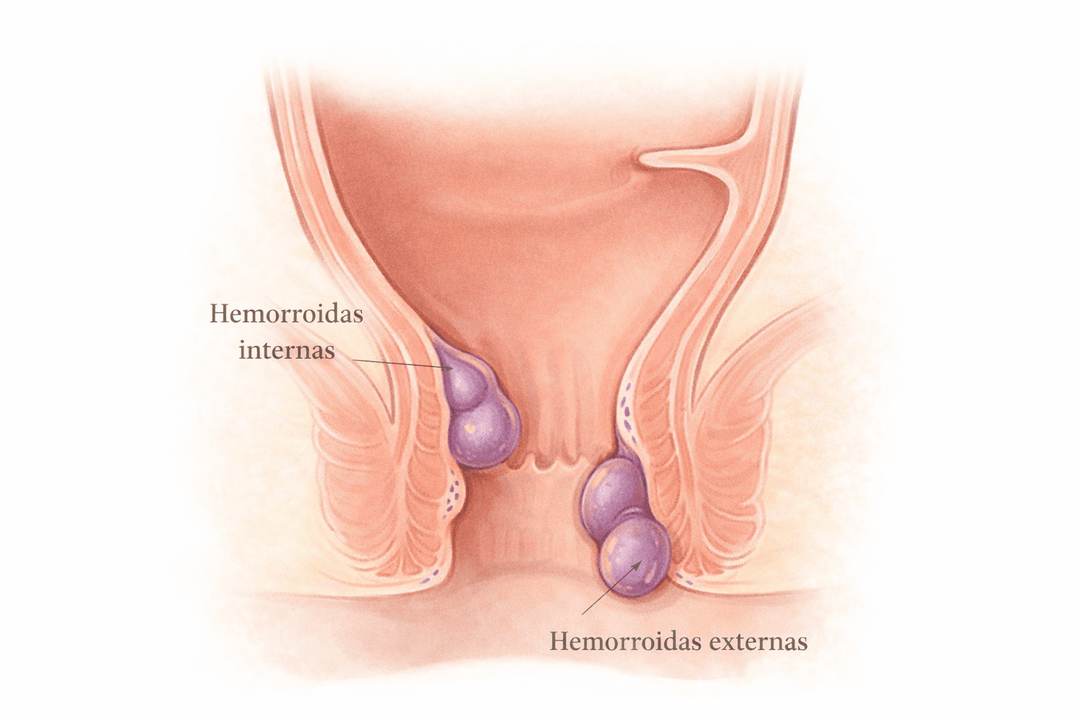 Ilustracao comparativa de hemorroidas internas e externas
