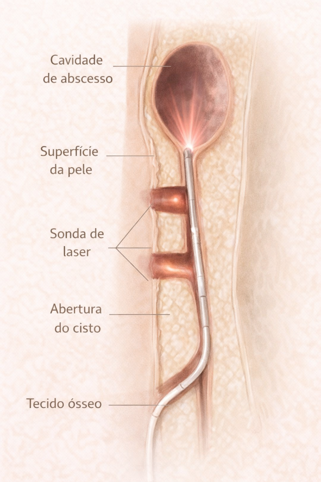Detalhamento anatômico do cisto pilonidal e da área acometida