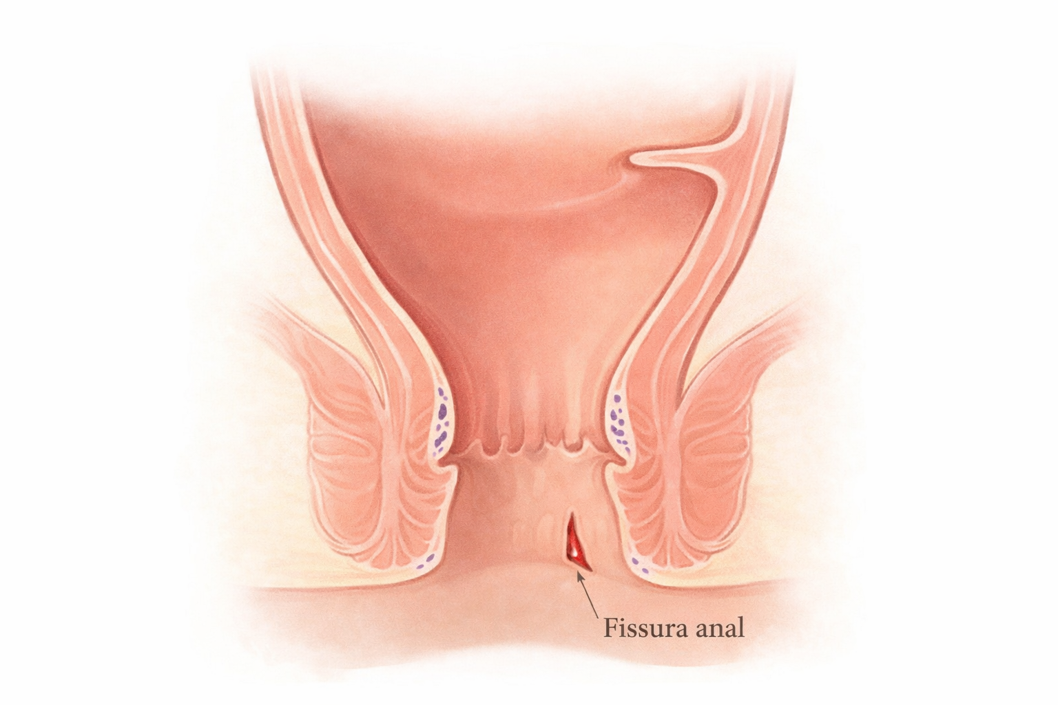 Ilustração de fissura anal e região acometida