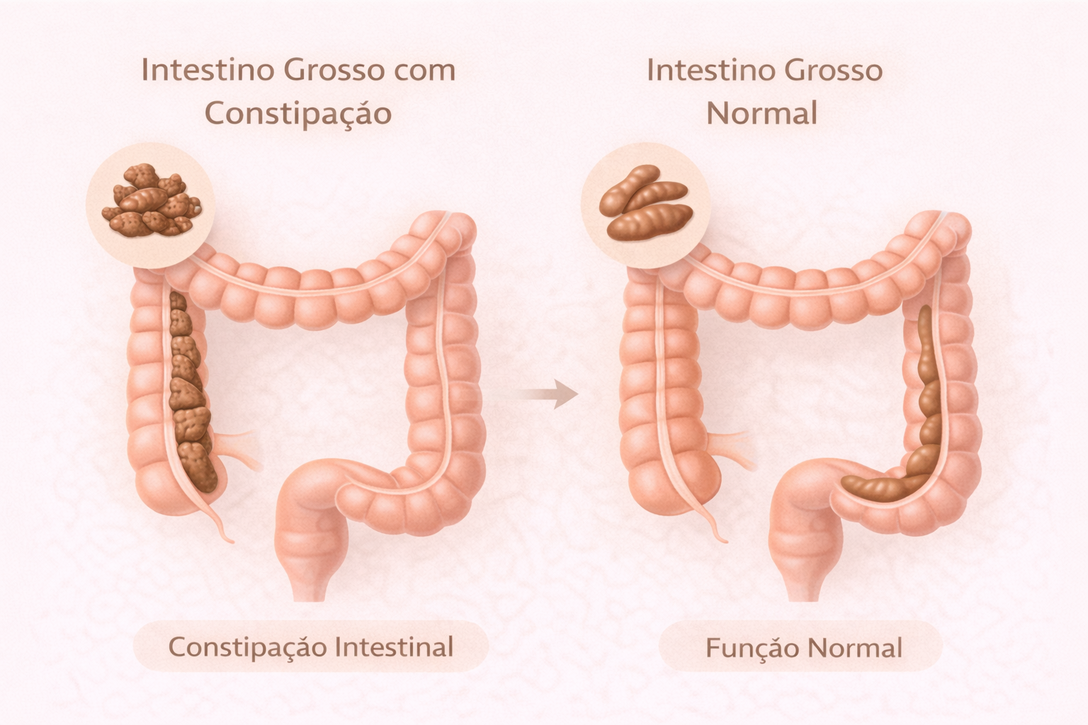 Ilustração do intestino grosso e funcionamento intestinal normal